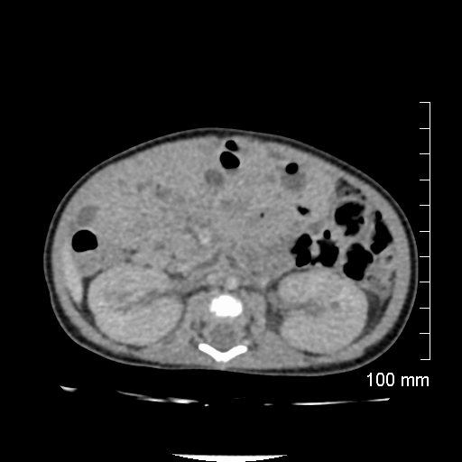 File:Neonatal neuroblastoma (Radiopaedia 56651-63438 Axial non-contrast 43).jpg
