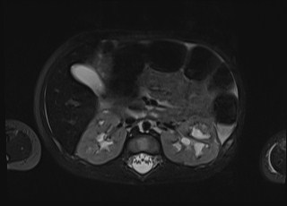 Neonatal prostatic utricle abscess - cyst (Radiopaedia 69511-79394 Axial T2 fat sat 54).jpg