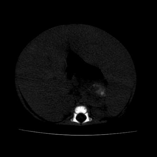 File:Neuroblastoma (Radiopaedia 20876-20799 Axial bone window 12).jpg