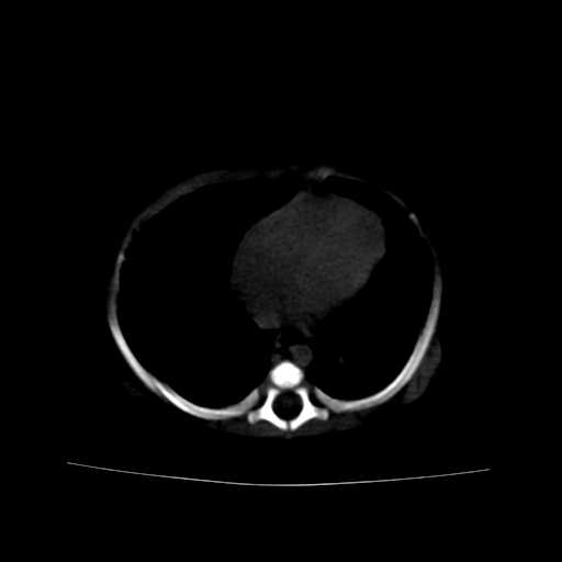 File:Neuroblastoma (Radiopaedia 20876-20799 Axial bone window 2).jpg