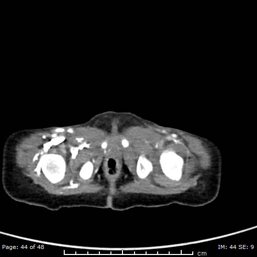 File:Neuroblastoma (Radiopaedia 41472-44355 A 44).jpg