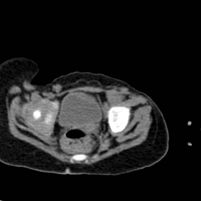 Neuroblastoma with skull metastases (Radiopaedia 30326-30960 Axial non-contrast 56).jpg