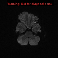 File:Neurofibromatosis type 1 with optic nerve glioma (Radiopaedia 16288-15965 Axial DWI 65).jpg