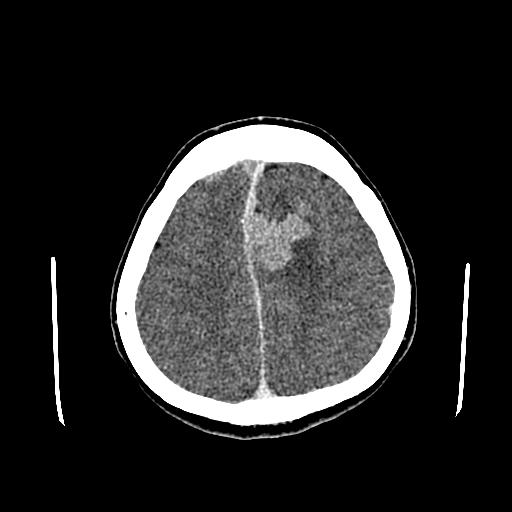 File:Neurofibromatosis type 2 (Radiopaedia 25389-25637 Axial C+ 77).jpg