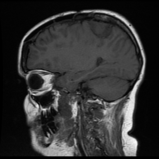 File:Neurofibromatosis type 2 (Radiopaedia 45229-49247 Sagittal T1 14).png