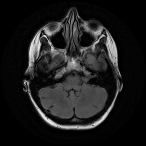 File:Neurofibromatosis type 2 - bilateral acoustic neuromata (Radiopaedia 40060-42566 Axial FLAIR 5).png