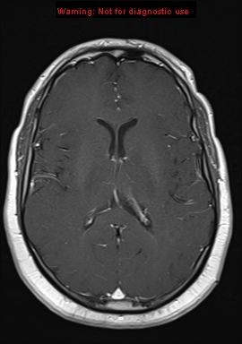 File:Neuroglial cyst (Radiopaedia 10713-11184 Axial T1 C+ 11).jpg