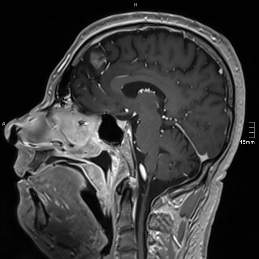 Neurosarcoidosis - involvement of the mesial temporal lobes (Radiopaedia 67429-76820 Sagittal T1 C+ 80).jpg