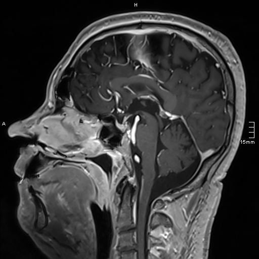 Neurosarcoidosis - involvement of the mesial temporal lobes (Radiopaedia 67429-76820 Sagittal T1 C+ 86).jpg