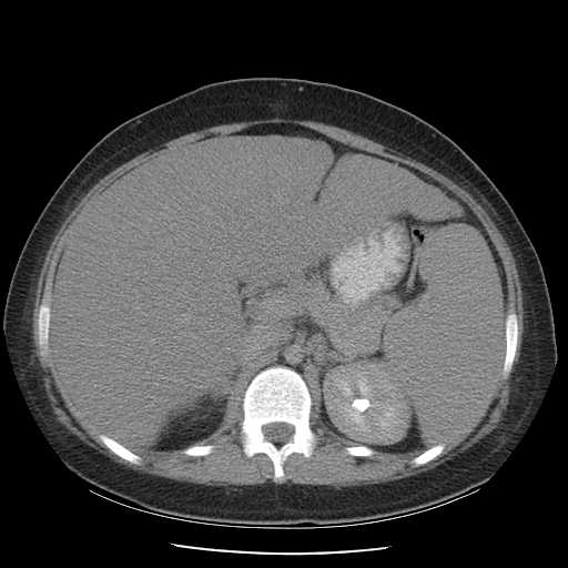 File:Non-Hodgkin lymphoma involving pelvis (Radiopaedia 21281-21197 B 24).jpg