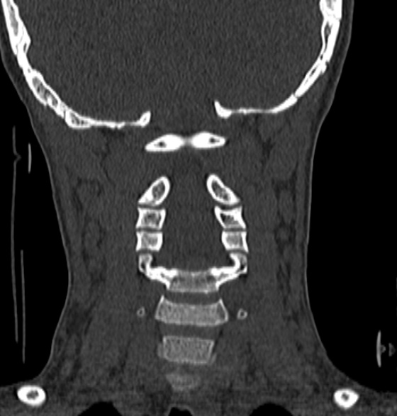 File:Normal CT cervical spine - 12-year-old (Radiopaedia 55352-61775 Coronal bone window 120).jpg