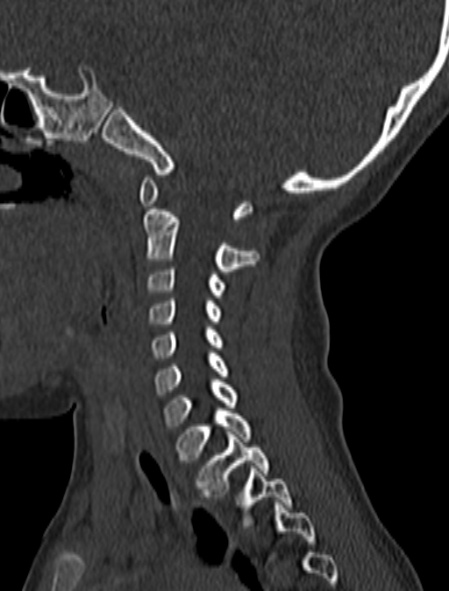 File:Normal CT cervical spine - pediatric (Radiopaedia 52549-58462 Sagittal bone window 138).jpg
