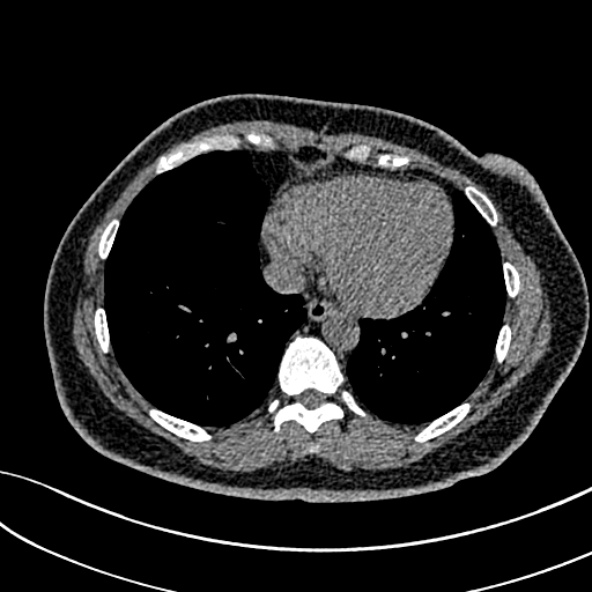 Normal CT chest- adult female (Radiopaedia 52522-58428 Axial non-contrast 92).jpg