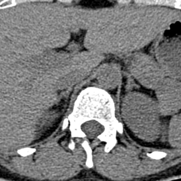 Normal CT lumbar spine (Radiopaedia 53981-60118 Axial non-contrast 1).jpg