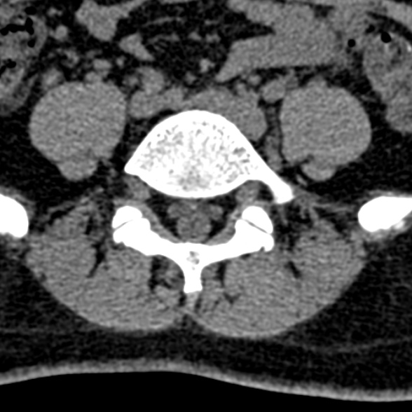 Normal CT lumbar spine (Radiopaedia 53981-60118 Axial non-contrast 81).jpg