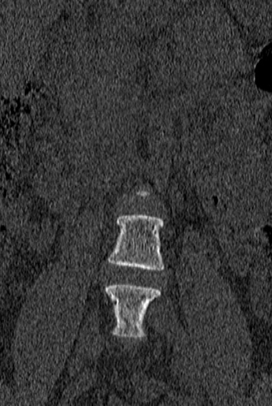 File:Normal CT lumbar spine (Radiopaedia 53981-60118 Coronal bone window 4).jpg