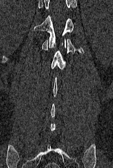 Normal CT lumbar spine (Radiopaedia 53981-60118 Coronal bone window 57).jpg