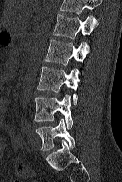 File:Normal CT lumbar spine (Radiopaedia 53981-60118 Sagittal bone window 62).jpg