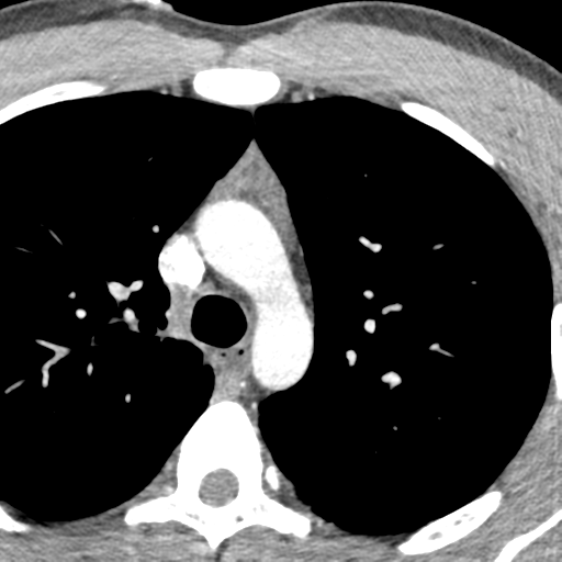 File:Normal CT pulmonary veins (pre RF ablation) (Radiopaedia 41748-44702 A 13).png