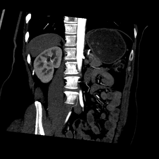 File:Normal CT renal artery angiogram (Radiopaedia 38727-40889 D 13).png