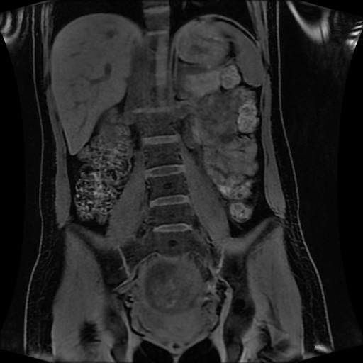 Normal MRI abdomen in pregnancy (Radiopaedia 88001-104541 M 85).jpg