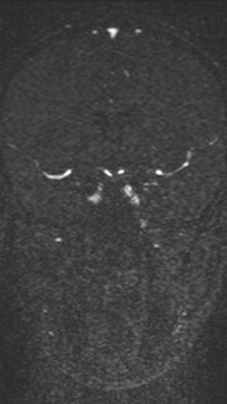 Normal MRI brain with MRV- teenager (Radiopaedia 49425-54553 Coronal MRV 110).jpg