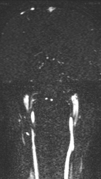 Normal MRI brain with MRV- teenager (Radiopaedia 49425-54553 Coronal MRV 148).jpg