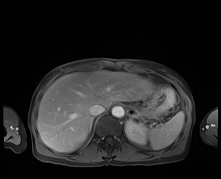 Normal adrenal glands MRI (Radiopaedia 82017-96004 M 19).jpg