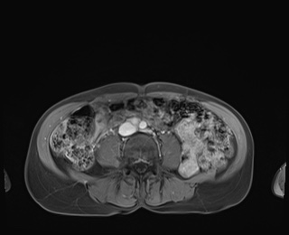 Normal adrenal glands MRI (Radiopaedia 82017-96004 M 66).jpg