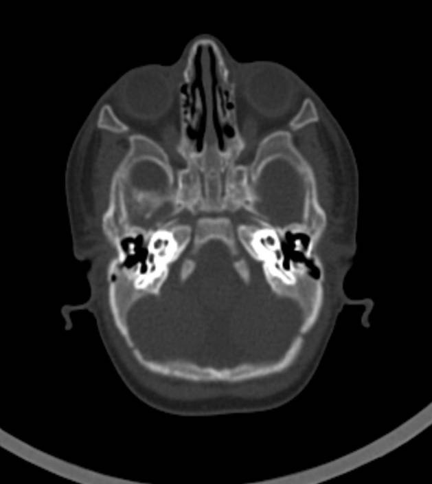 Normal brain CT - 2-month-old (Radiopaedia 53369-59350 Axial bone window 50).jpg