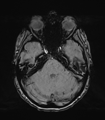 Normal brain MRI (TLE protocol) (Radiopaedia 40748-43405 Axial SWI 26).png