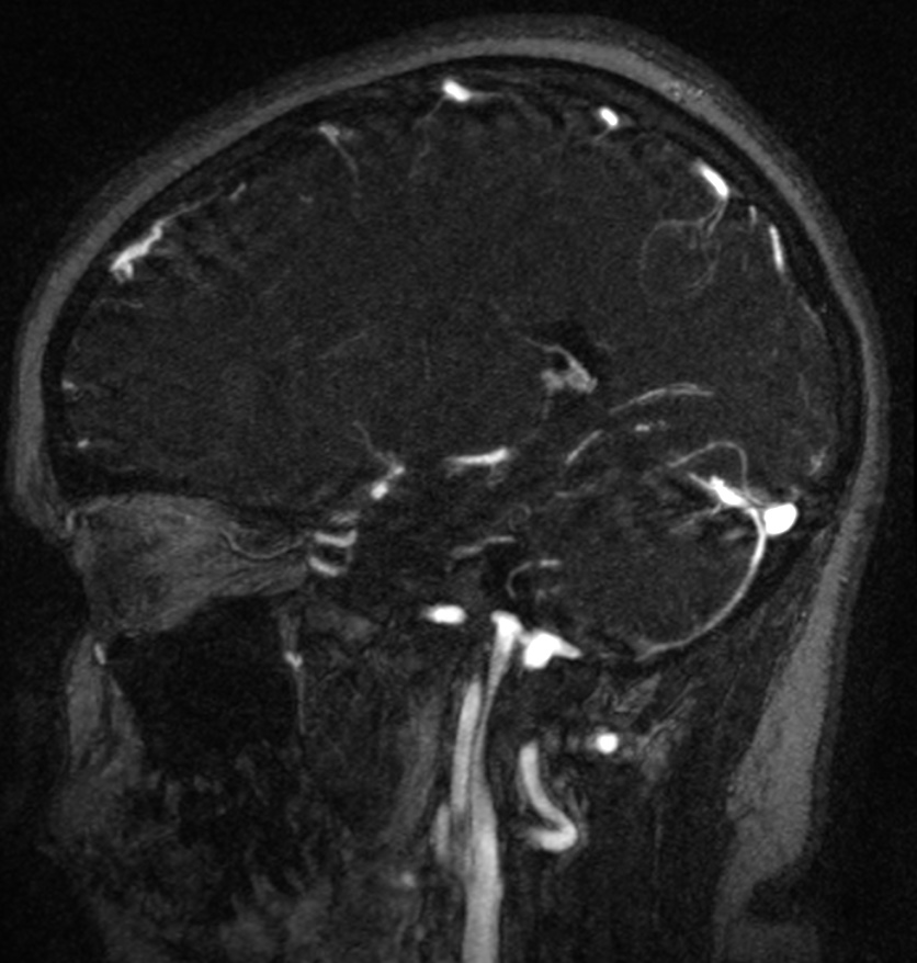 Normal brain MRI and venogram (Radiopaedia 39554-41862 Sagittal MRV 23).jpg