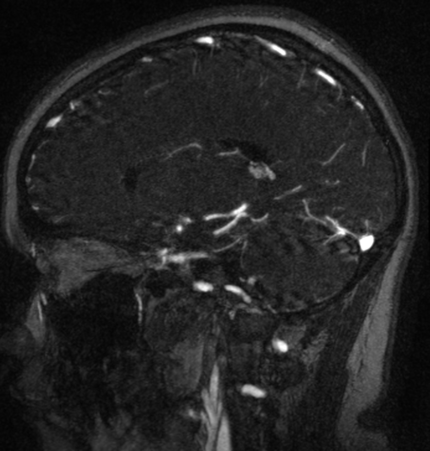 Normal brain MRI and venogram (Radiopaedia 39554-41862 Sagittal MRV 25).jpg