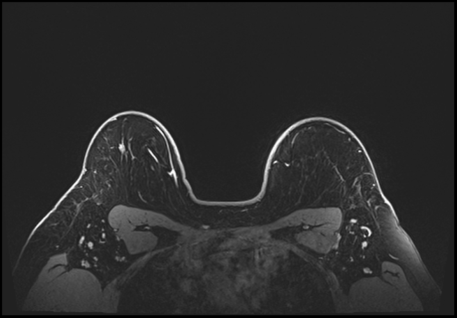 Normal breast MRI - dense breasts (Radiopaedia 80454-93850 C 185).jpg