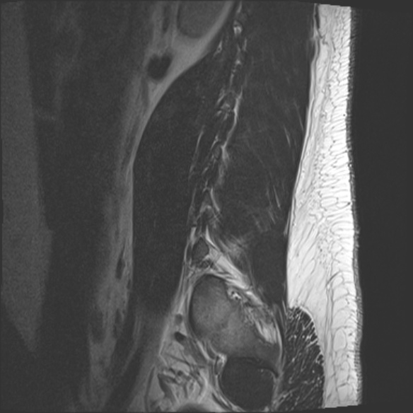 File:Normal lumbar spine MRI (Radiopaedia 47857-52609 Sagittal T2 20).jpg