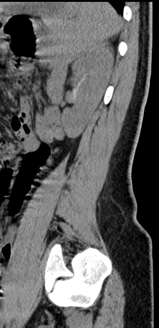Normal lumbosacral CT (Radiopaedia 37923-39867 E 23).png
