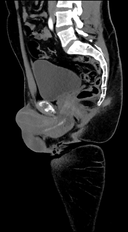 Normal pelvis CT angiogram (Radiopaedia 84966-100481 C 54).jpg