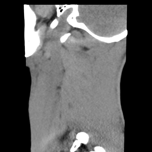 File:Normal trauma cervical spine (Radiopaedia 41017-43760 B 27).png
