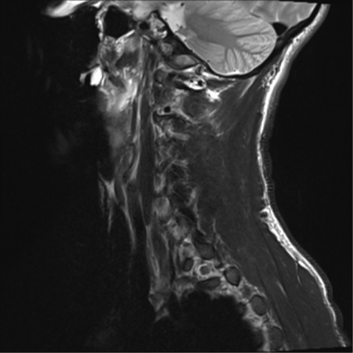 File:Normal trauma cervical spine (Radiopaedia 41017-43762 Sagittal T2 1).png