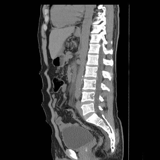 File:Obstructed kidney with perinephric urinoma (Radiopaedia 26889-27066 B 35).jpg