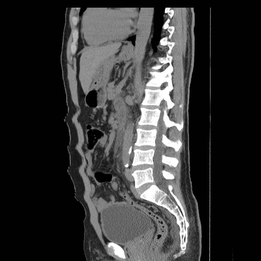 File:Obstructed kidney with perinephric urinoma (Radiopaedia 26889-27066 B 37).jpg