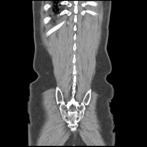 Obstructing renal calculus (Radiopaedia 29517-30016 Coronal non-contrast 48).jpg