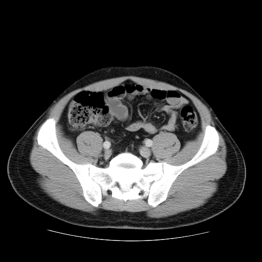 File:Obstructing ureteric calculus (Radiopaedia 18615-18514 B 41).jpg