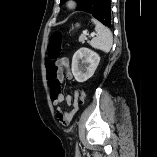 Obstructing ureteric calculus (Radiopaedia 49281-54373 C 26).jpg