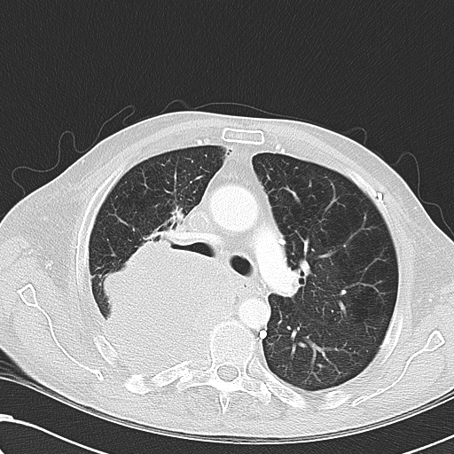 File:Obstructive superior vena cava tumor thrombus (Radiopaedia 28046-28306 Axial lung window 21).jpg