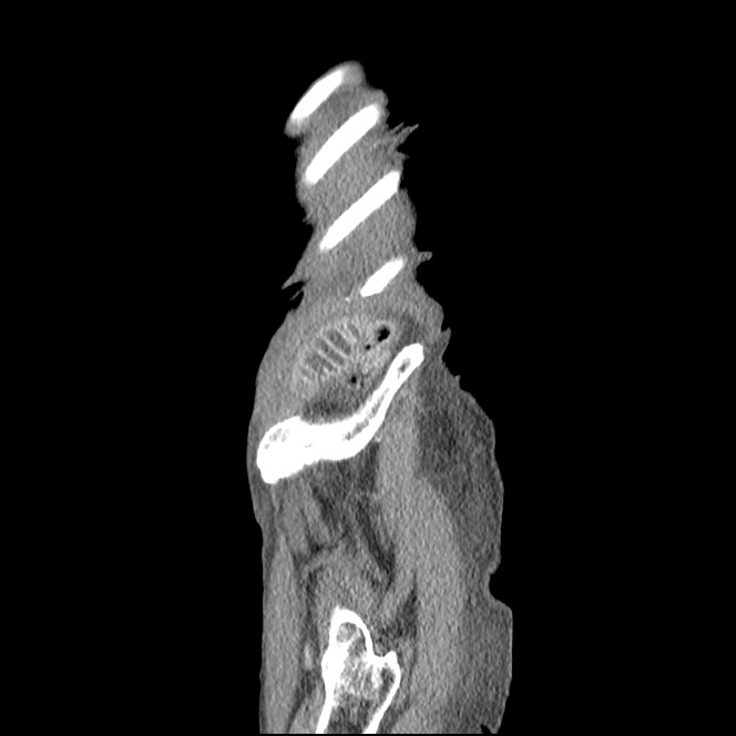 Obturator hernia causing small bowel obstruction (Radiopaedia 65522-74612 C 7).jpg