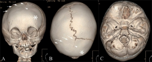 Anterior plagiocephaly- a)Anterior b) vertex and c) endocranial