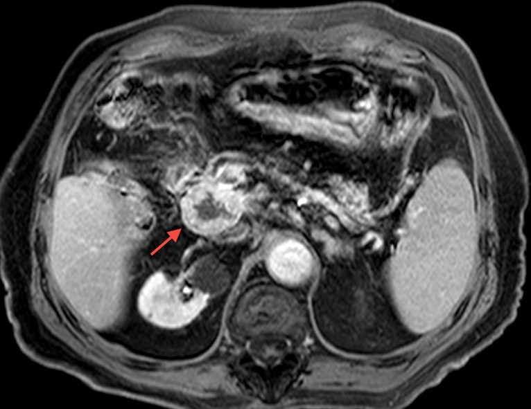 File:Pancreatic neuroendocrine tumor (Radiopaedia 25769).jpg