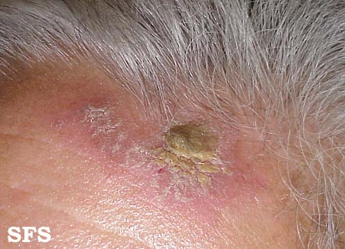 File:Psoriasis (Dermatology Atlas 19).jpg