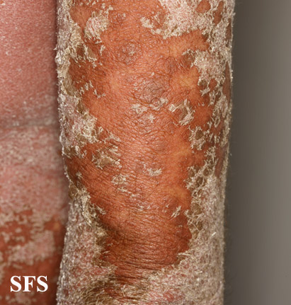 File:Psoriasis (Dermatology Atlas 77).jpg